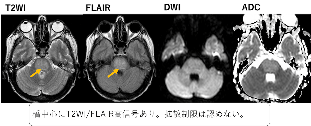 浸透圧性脱髄症候群とは？MRI画像診断のポイント！(橋中心髄鞘崩壊症)